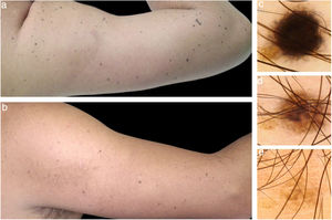 Imagens de seguimento clínico e dermatoscópico. (A), Múltiplas pequenas máculas enegrecidas e marrons no membro superior direito. (B), Sete anos depois, a maioria dos nevos de Spitz regrediu completamente. (C–E), Seguimento dermatoscópico de um nevo representativo. (C), Padrão estelar (starburst), área central de pigmentação preta homogênea e estrias periféricas distribuídas simetricamente. (D), padrão homogêneo marrom. (E), Nevo em regressão.