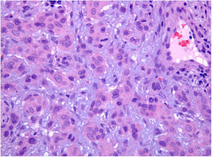 Exame histopatológico. Células neoplásicas dentro de um estroma mixoide (Hematoxilina & eosina, 200×).
