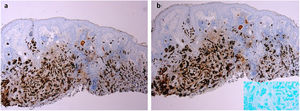 Imuno‐histoquímica da lesão. (a), Imunomarcação positiva para receptores de estrogênio (20×). (b), Imunomarcação positiva para receptores de progesterona (20×).