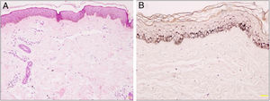 Histopatologia da ABTM. (A), Hiperpigmentação da camada basal da epiderme, proliferação e dilatação de capilares com pequeno infiltrado linfo‐histiocitário perivascular na derme superior (Hematoxilina & eosina, 100×). (B), Hiperpigmentação na camada basal da epiderme (Fontana‐Masson, 200×).