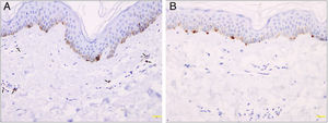 Análise imuno‐histoquímica revelando mastócitos e melanócitos na ABTM. (A), Alguns mastócitos positivos para CD117 (setas) ao redor dos capilares dilatados na derme papilar (200×). (B), Melanócitos normais positivos para Melan‐A na epiderme (200×).