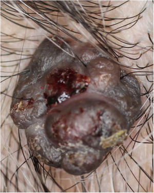 Aparência clínica de um nódulo enegrecido, semipedunculado, de 12mm, no lado esquerdo do couro cabeludo.