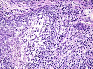 Infiltrado inflamatório denso predominantemente mononuclear no interior do maciço neoplásico (Hematoxilina & eosina, 400×).