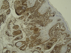 Positividade para Bcl‐2 apenas nas células tumorais mais externas (IMQ, 100×).