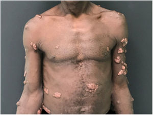 Múltiplos nódulos queilodianos disseminados no tegumento.