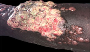 Placa vegetante, ulcerada, friável, localizada na porção anterior da perna esquerda, medindo cerca de 12 cm, com presença de lesões queilodianas satélites.