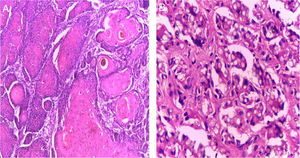 (A), Exame anatomopatológico compatível com carcinoma espinocelular bem diferenciado (Hematoxilina & eosina, 40×). (B), Derme adjacente à lesão neoplásica evidenciando a presença de numerosas estruturas fúngicas compatíveis com Lacazia loboi (Hematoxilina & eosina, 100×).
