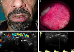 (A), Fotografia clínica mostrando tumoração eritemato‐violácea, não ulcerada, de partes moles no lado esquerdo do lábio inferior. (B), Fotografia dermatoscópica da lesão mostrando vaso sanguíneo linear e tortuoso com microulcerações superficiais. (C), Uma artéria submucosa de 15 × 4,7mm de espessura com um canal transversal subjacente é observada nessa imagem de Doppler colorido. (D), O fluxo pulsátil da artéria era claramente visível no Doppler colorido em tempo real.