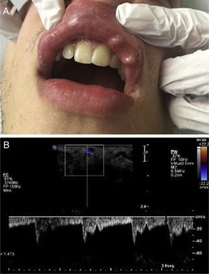 (A), Fotografia clínica mostrando um nódulo expansivo, azul‐avermelhado, translúcido e pulsátil no lado direito do lábio inferior, medindo 7mm. (B), A análise espectral e colorida simultânea usando ultrassom com Doppler mostra um fluxo direto de alta resistência em um ramo da artéria labial inferior de grande diâmetro no lábio inferior.