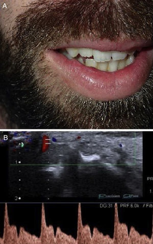 (A), Fotografia clínica mostrando dois nódulos assintomáticos, translúcidos e pulsáteis de 1cm cada, no lado esquerdo do lábio superior. (B), O ultrassom com Doppler colorido com análise da curva espectral confirma o fluxo sanguíneo arterial dentro da lesão.