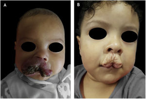 Sequela inestética: (A, paciente com hemangioma infantil ulcerado no lábio aos 4 meses de idade e (B), cicatriz e pele redundante aos 2 anos de idade.
