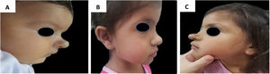 Exemplo de crescimento tardio de hemangioma da infância. (A), Perfil do paciente com hemangioma cyrano aos 2 meses de idade antes do tratamento. (B), Perfil do paciente no final do tratamento, aos 3 anos e 2 meses de idade com propranolol. (C), Perfil do paciente aos 4 anos e 7 meses, apresentando crescimento tardio.
