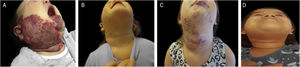 Exemplo de crescimento tardio de hemangioma da infância. (A), Paciente com síndrome PHACES aos 2 meses de idade antes do tratamento. (B), Paciente com 1 ano e 10 meses – no final do tratamento com propranolol. (C), Paciente em 4 anos e 6 meses, com crescimento tardio de hemangioma, quando o tratamento com propranolol foi reiniciado. (D), Paciente aos 6 anos de idade, mostrando regressão do hemangioma.