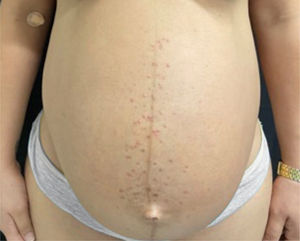 Pápulas eritematosas e pústulas localizadas no esterno e no abdome (linha nigra).