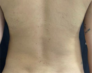 Pápulas eritematosas localizadas no dorso.