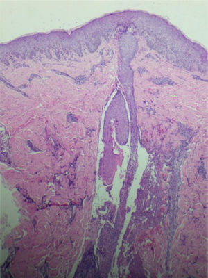 Observa‐se infiltrado perivascular composto predominantemente por linfócitos na derme (Hematoxilina & eosina, 40×).