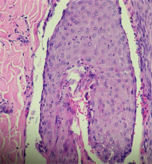 Folículo piloso permeado por infiltrado inflamatório constituído predominantemente por neutrófilos levando à destruição da estrutura folicular (Hematoxilina & eosina, 400×).