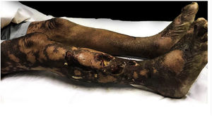 Placas ulceradas com necrose e presença de fibrina.