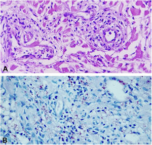 (A), Cortes histológicos mostram infiltrado neutrofílico ao redor dos vasos, com agressão de parede e discreto depósito de fibrina (Hematoxilina & eosina, 400×). (B), Ziehl‐ Neelsen, 400×.