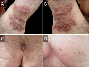 Hidradenite supurativa na axila esquerda (A), e na axila direita (B), antes da intervenção cirúrgica. (C), Cisto pilonidal sacrococcígeo. (D), Cicatriz do tipo “ice pick” resultante de acne grave.