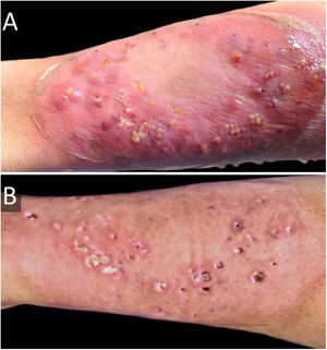 (A), Pioderma gangrenoso (lesão eritematosa com bolhas, pústulas e fundo violáceo) na perna esquerda antes dos antibióticos intravenosos de amplo espectro e corticosteroides tópicos de alta potência. (B), Um mês após o tratamento; cicatrizes cribriformes podem ser vistas.