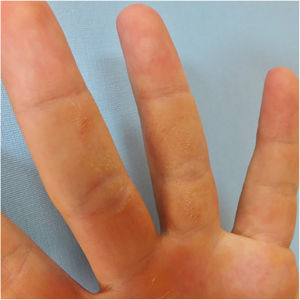 Pápulas agrupadas assintomáticas, puntiformes, hiperceratóticas na face palmar da terceira e quarta falanges da mão esquerda de um homem de 24 anos.