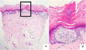 (A), Duas áreas em forma de “ball‐and‐claw” no meio e no lado direito da imagem (Hematoxilina & eosina, 40×). (B), Colarete epidérmico ao redor do infiltrado linfo‐histiocítico subepidérmico e um foco paraceratótico localizado logo acima dele (Hematoxilina & eosina, 200×).