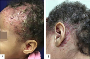 (A), Lesões eritêmato‐descamativas, infiltradas, recobertas por crostas hemáticas e melicéricas em todo o couro cabeludo e pavilhão auricular. (B), Pápulas eritematosas coalescentes, encimadas por crostas hemáticas e melicéricas se estendendo desde a região temporal até retroauricular.