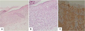 (A), Epiderme com espongiose e focos de dano hidrópico basal, derme superficial com moderado e difuso infiltrado inflamatório em faixa (Hematoxilina & eosina, 100×). (B), Células dotadas de núcleos ovalados, focalmente lobulados, além de linfócitos maduros e alguns eosinófilos (Hematoxilina & eosina, 200×). (C), Positividade difusa para CD1A (200×).