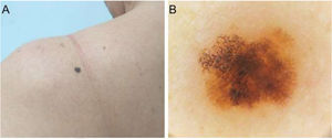 (A), Melanoma in situ. Diâmetro clínico de 4mm. (B), Dermatoscopia mostra uma rede atípica com áreas hiperpigmentadas irregulares.