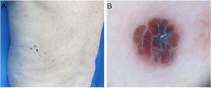 (A), Melanoma invasivo de 0,75mm de espessura de Breslow e diâmetro de 3mm. (B), Dermatoscopia mostra um padrão multicomponentes com áreas sem estrutura de cor castanha, área amorfa atípica, estruturas brancas brilhantes e vasos serpiginosos.