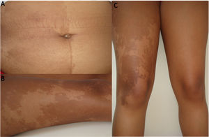 (A), Mancha hipercrômica segmentar café‐com‐leite no abdome, com distribuição semelhante a um tabuleiro de xadrez, respeitando a linha média do corpo. (B e C), Mancha hipercrômica segmentar café‐com‐leite na coxa direita com contorno geográfico.