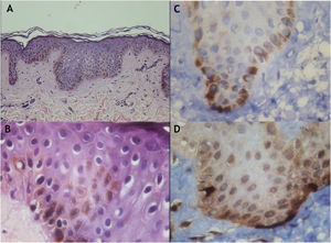 Microscopia óptica. (A), Aumento do pigmento melanina na coloração pela Hematoxilina & eosina (150×). (B), Aumento do pigmento melanina na coloração pela Hematoxilina & eosina, que também foi observado nas camadas suprabasais (400×). (C), A imuno‐histoquímica com marcador melanocítico (HMB‐45) confirmou um aumento de melanina e revelou um número normal de melanócitos (400×). (D), A imuno‐histoquímica com marcador melanocítico (HMB‐45) confirmou um aumento de melanina e revelou um número normal de melanócitos (400×).
