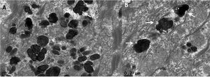 Microscopia eletrônica de transmissão (A e B). Detalhe de melanossomas com recortes em seu contorno (50,000×).