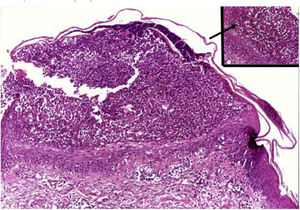 Psoríase pustulosa: pústula subcórnea, de tipo espongiforme (inset, seta). Hematoxilina & eosina, 100× e 400× (inset).