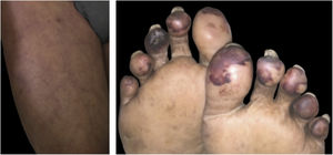 Livedo racemoso, púrpura e necrose de extremidades em paciente com COVID‐19.