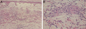 Achados histopatológicos de exantema em paciente com COVID‐19. (A), Presença de vasculite leucocitoclástica dos vasos capilares da derme superficial e eritrodiapedese (Hematoxilina & eosina, 100×). (B), Em detalhe vasos capilares contendo neutrófilos íntegros e degenerados destruindo parcialmente a parede, hemácias extravasadas e a presença de material amorfo eosinofílico no lúmen vascular sugestivo de trombo de fibrina (Hematoxilina & eosina, 400×).