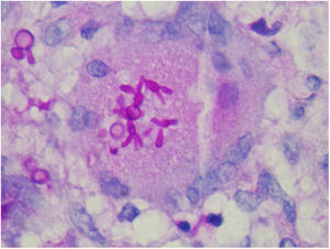 Exame histopatológico de paciente com forma disseminada. Células leveduriformes em forma de “charuto” (PAS, 400×).