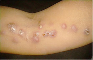 Esporotricose cutâneo‐linfática. Nódulos com saída de material seropurulento, pápulo‐pústulas no membro superior direito ao longo da cadeia linfatica ipsilateral.