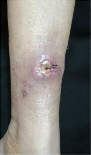 Esporotricose cutânea fixa – lesão solitária em placa, ulcerada com bordas eritematosas e fundo seroso.