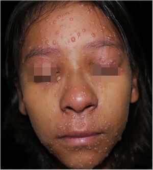 Momento de admissão hospitalar, quinto dia de evolução da doença. Vesículas e bolhas em face; pústula em pálpebra inferior direita.