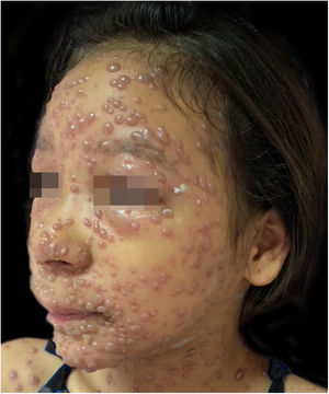 Sétimo dia de evolução. Bolhas com base eritematosa.