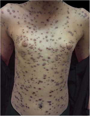 Sessenta dias após a alta hospitalar. Manchas hipocrômicas residuais.