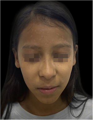 Sétimo dia de internação hospitalar. Bolhas em regressão e crostas.