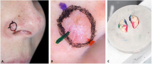“DerMohscopia”. (A), Marcações de orientação coloridas. (B), Documentação fotográfica da dermatoscopia mapeada. (C), Espécime cirúrgico pintado com as mesmas cores das marcações no paciente.
