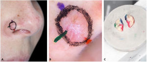 “DerMohscopia”. (A), Marcações de orientação coloridas. (B), Documentação fotográfica da dermatoscopia mapeada. (C), Espécime cirúrgico pintado com as mesmas cores das marcações no paciente.