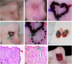Demarcação pré‐operatória de áreas com dermatoscopia suspeita. (A e B), CBC infiltrativo mal delimitado. (C), Margens do 1° estágio. (D e E), Área suspeita demarcada em pontilhado para remoção posterior caso necessário. (F), Peça cirúrgica corada. (G e H), CBC nas marcações verde e vermelha (Hematoxilina & eosina, 25×). (I), Ferida operatória final.
