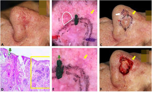 Correlação dos achados dermatoscópicos e histopatológicos em caso de margens comprometidas. (A), CBC mal delimitado. (B), Mapeamento dermatoscópico. Após avaliação cautelosa, a área branca foi incluída na margem do 1° estágio. (C), Margem do 1° estágio. (D), Margem lateral comprometida (retângulo amarelo) adjacente à marcação verde (Hematoxilina & eosina, 25×). (E), A seta amarela indica a área correspondente à margem comprometida na histopatologia; áreas brancas rosadas sem estrutura na dermatoscopia. (F), Ferida operatória, a seta amarela indica a área removida no 2° estágio.
