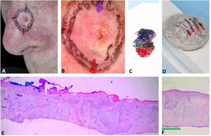 Mapeamento do debulking. (A), CBC mal delimitado. (B), Dermatoscopia do tumor. (C), Debulking mapeado com cores semelhantes à dermatoscopia. (D), Cortes verticais do debulking previamente à inclusão. (E e F), A histopatologia demonstrou predominantemente CBC infiltrativo na área azul e CBC superficial na área verde (Hematoxilina & eosina, 40×).