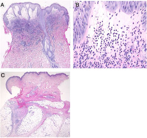(A), Características histológicas mostrando densa infiltração de neutrófilos em toda a derme edematosa (Hematoxilina & eosina, aumento original 40×). (B), Um aumento maior mostrou vários neutrófilos infiltrados (Hematoxilina & eosina, 400×). (C), Exame histológico do nódulo subcutâneo da extremidade inferior mostrando paniculite septal (Hematoxilina & eosina, 20×).